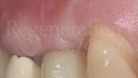 RC 9 mesi: dettaglio del profilo della mucosa peri-implantare.