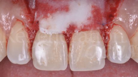 La matrice viene fissata sugli elementi dentari a copertura delle recessioni con suture in acido poliglicolico 6/0.