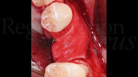 11. La membrana è fissata con pin sul versante linguale e vestibolare.