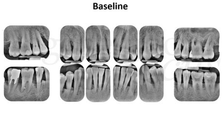 Radiografie endorali alla baseline.