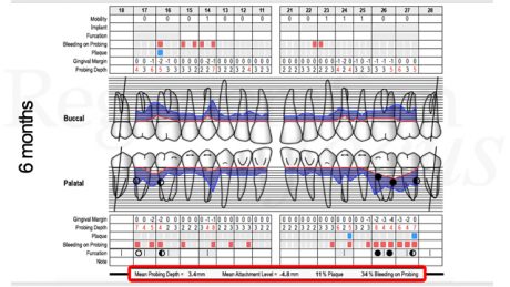 Cartella parodontale 6 mesi dopo il trattamento.