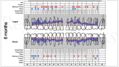 Cartella parodontale 6 mesi dopo il trattamento.