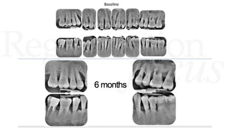 Radiografie endorali 6 mesi dopo il trattamento.