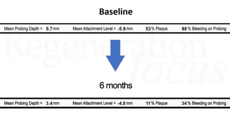 Parametri parodontali alla baseline e 6 mesi dopo il trattamento.