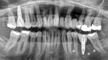 22. Ortopantomografia a 18 mesi