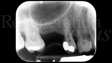 2. Situazione radiografica iniziale