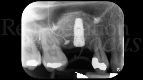 10. Radiografia dopo 6 mesi