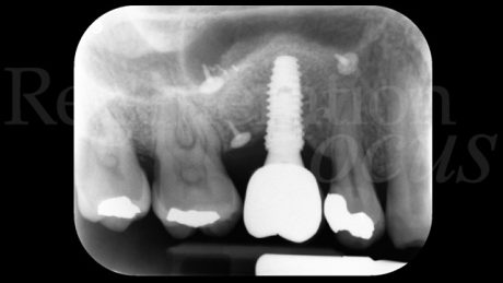 11. Radiografia con la protesi definitiva dopo 5 anni