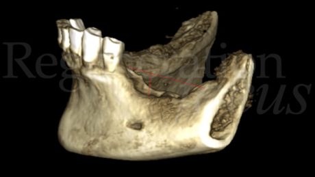 2. CBCT che mostra il difetto osseo verticale.