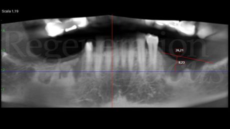 1. Panoramica che evidenzia la grave atrofia ossea verticale dovuta agli esiti degli impianti in perimplantite.