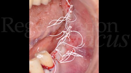 8. Sutura in PTFE 3.0 materassaio orizzontale e punti staccati nello svincolo anteriore 6.0 monofilamento.