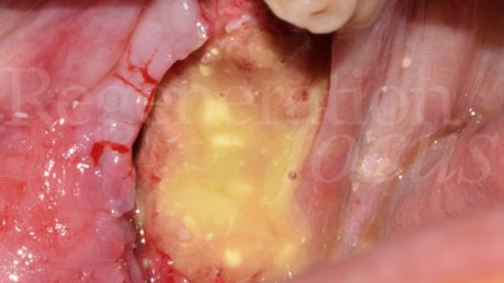 12. Pulizia della parte contaminata e abbondante lavaggi con fisiologica e applicazione di un putty doxicillina per 2 minuti.