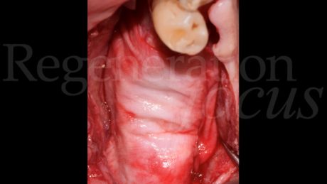 13. Posizionamento di una membrana in collagene (Geistch Bio-Gide®).