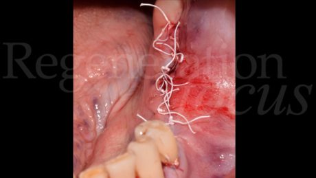 14. Sutura in PTFE 3.0 materassaio orizzontale e punti semplici.