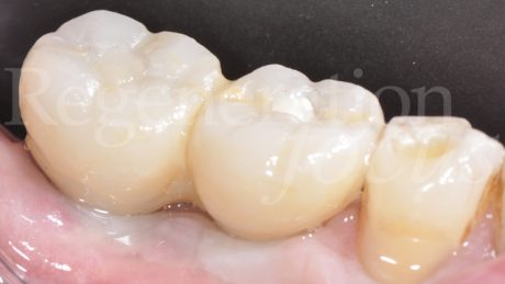 24. Protesi definitive con corone avvitate in zirconio.