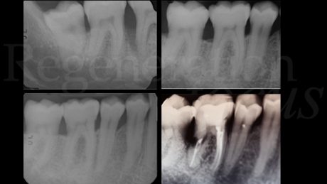 1. Situazione radiografica che mostra la condizione dei tessuti duri negli anni