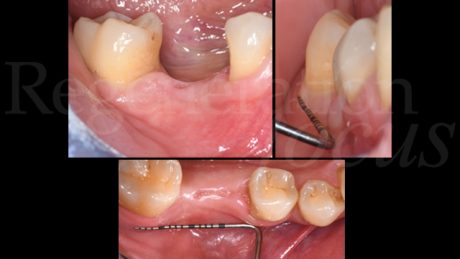 2. Situazione clinica iniziale a 6 mesi dall'estrazione