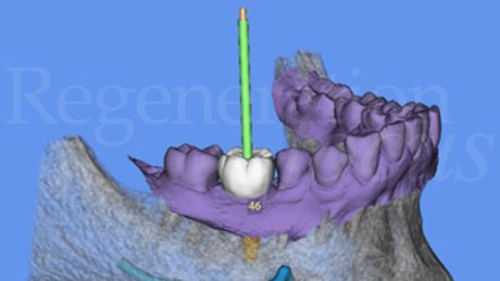 3. Pianificazione  dell'inserimento implantare