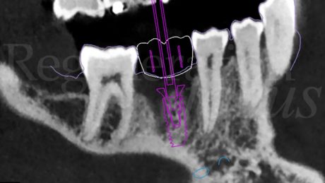 4. Pianificazione  dell'inserimento implantare