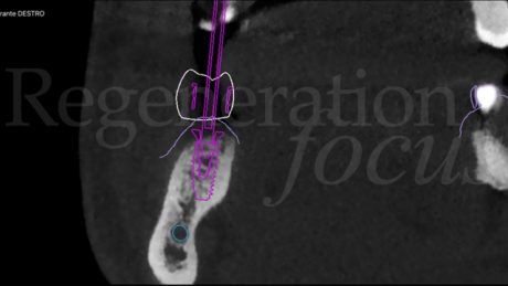 5. Pianificazione dell'inserimento implantare