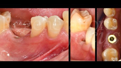 7. Situazione clinica 12 mesi dopo l'inserimento implantare