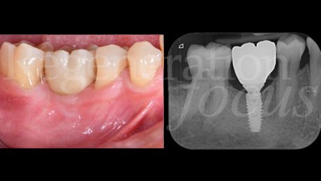 8. Situazione clinica 12 mesi dopo l'inserimento implantare