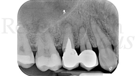 1. Radiografia endorale periapicale iniziale.