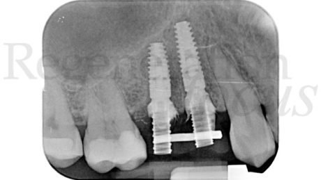 11. Controllo radiografico al termine della chirurgia.