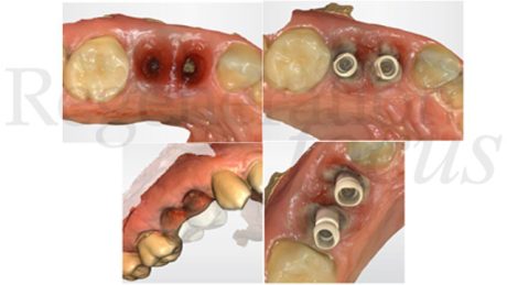 13. Scansione intraorale dei tragitti transmucosi e dei due scanbody.