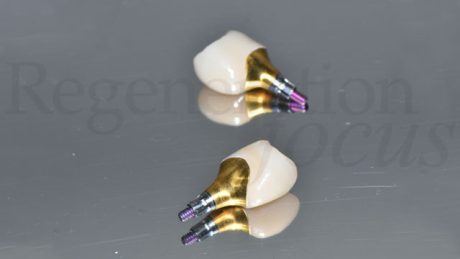 14. Corone definitive in zirconia monolitica.