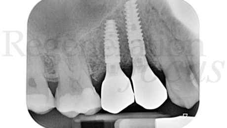 17. Radiografia endorale al follow-up a 8 mesi.