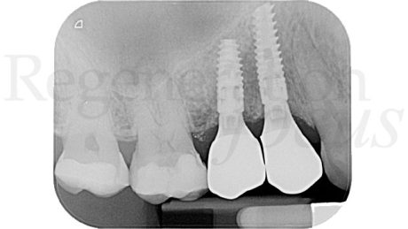 19. Radiografia endorale al follow-up a 14 mesi.