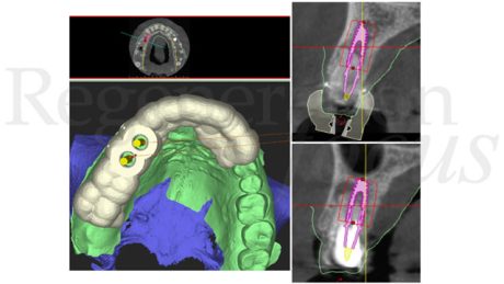 2. Pianificazione implantare pre-operatoria attraverso software di chirurgia-guidata.