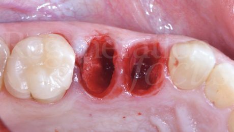 4. Situazione clinica dopo l’estrazione degli elementi 1.4 e 1.5.