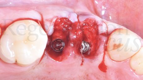 9. Inserimento della matrice Geistlich Fibro-Gide nella porzione vestibolare.