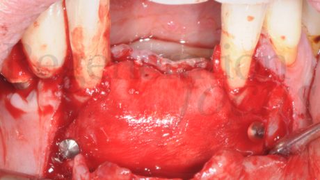 10. Membrana fissata con pin in titanio