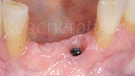 16. Ottima maturazione dei tessuti molli peri-implantari a 6 mesi