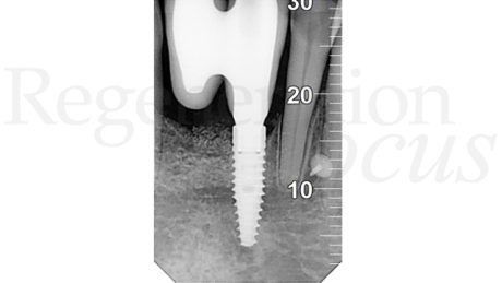 19. Controllo radiografico a 2 anni