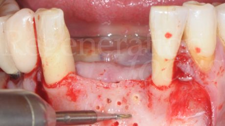 4. Perforazioni della corticale ossea
