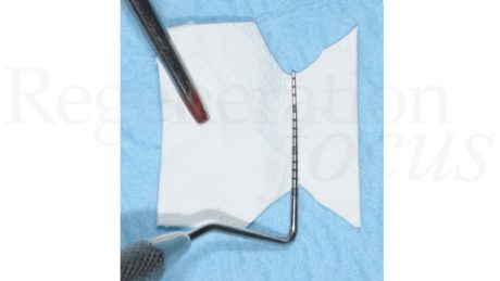 7. Sagomatura della membrana in collagene (Geistlich Bio-Gide®)