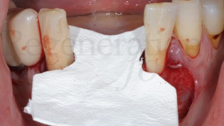 8. Applicazione della membrana in collagene