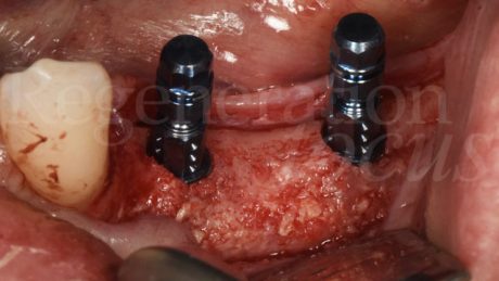 9. Inserimento degli impianti