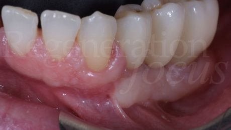 15. Ponte in zirconio monolitico avvitato