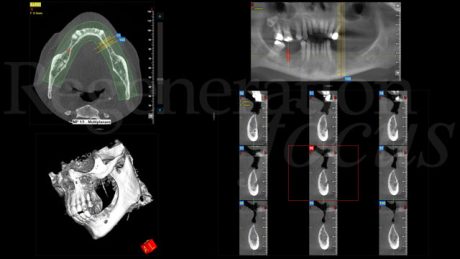 1. Immagine radiografica/CBCT iniziale