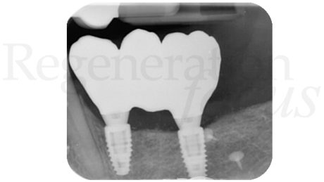 18. Follow up radiografico a 36 mesi