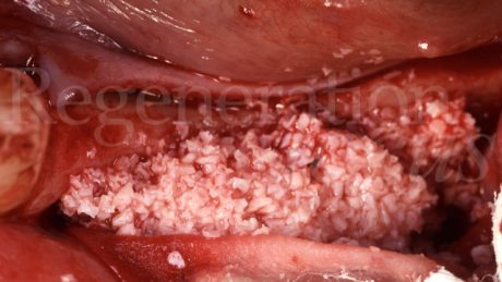 3. Utilizzo di Geistlich Bio-Oss®