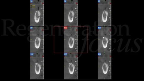 6. CBCT a 6 mesi