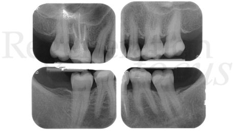 10. Il controllo radiografico conferma la stabilità e la maturazione del tessuto parodontale profondo
