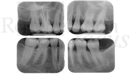 4. Radiografie periapicali nelle sedi di recidiva di parodontite