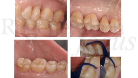 5. Utilizzo di Pocket-X® gel